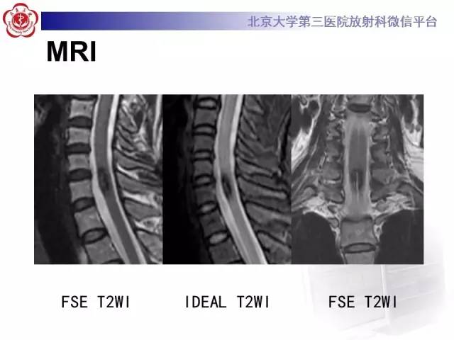 【病例】颈髓海绵状血管瘤1例MR影像表现