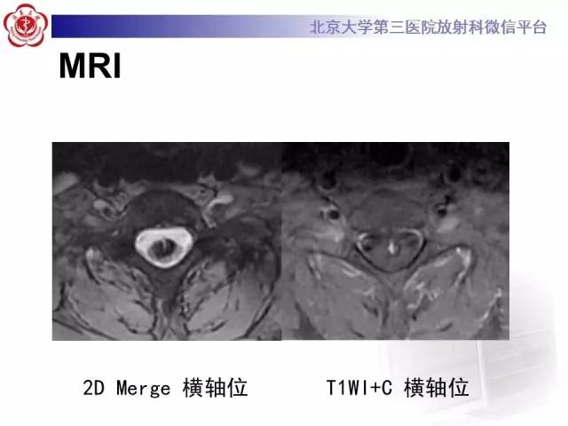 【病例】颈髓海绵状血管瘤1例MR影像表现