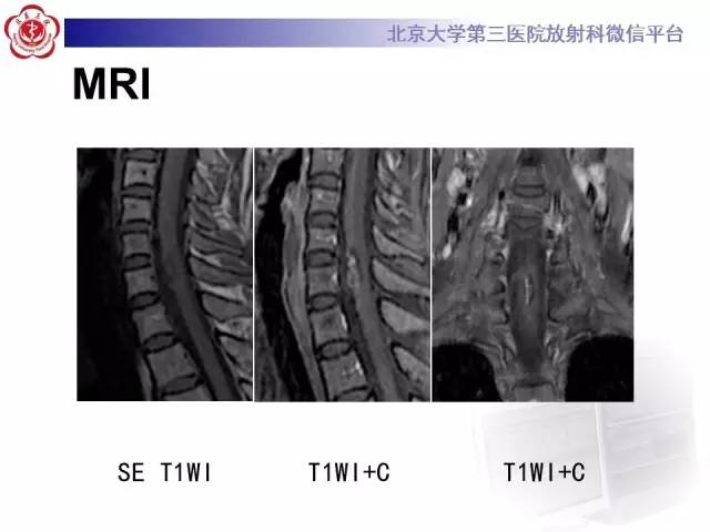 【病例】颈髓海绵状血管瘤1例MR影像表现