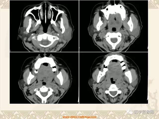 【病例】慢性腮腺炎1例CT影像表现