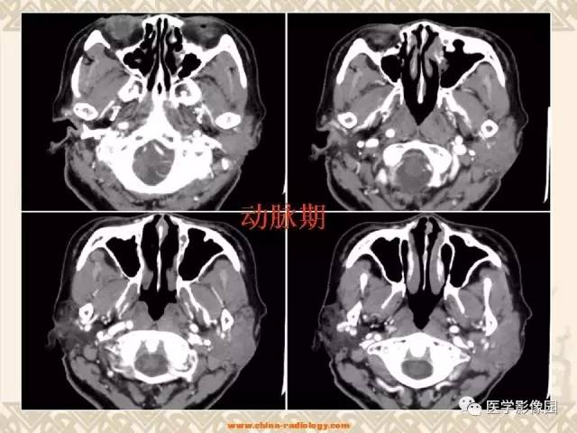 【病例】慢性腮腺炎1例CT影像表现 【病例】慢性腮腺炎1例CT影像表现