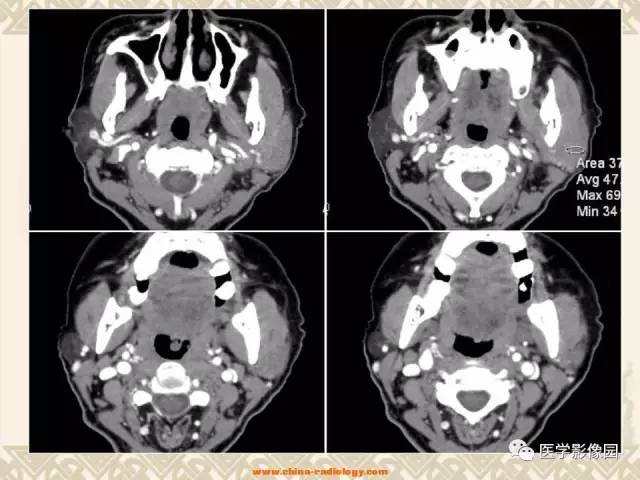 【病例】慢性腮腺炎1例CT影像表现 【病例】慢性腮腺炎1例CT影像表现