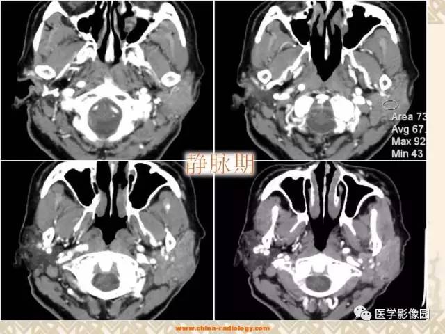 【病例】慢性腮腺炎1例CT影像表现 【病例】慢性腮腺炎1例CT影像表现