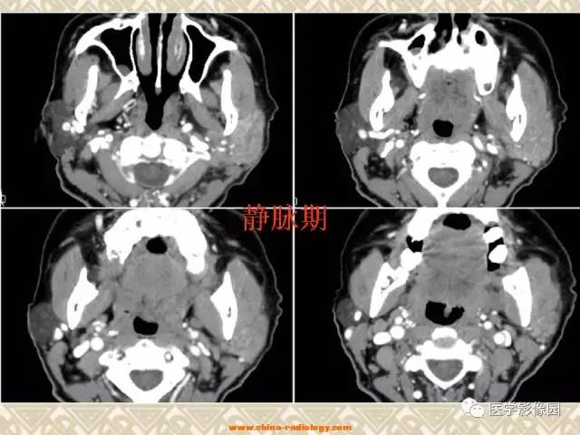 【病例】慢性腮腺炎1例CT影像表现 【病例】慢性腮腺炎1例CT影像表现