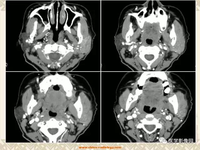 【病例】慢性腮腺炎1例CT影像表现 【病例】慢性腮腺炎1例CT影像表现