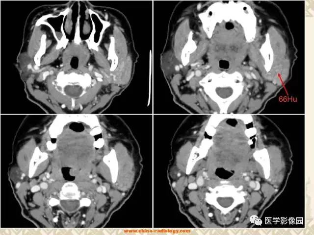 【病例】慢性腮腺炎1例CT影像表现 【病例】慢性腮腺炎1例CT影像表现