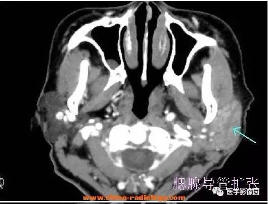 【病例】慢性腮腺炎1例CT影像表现 【病例】慢性腮腺炎1例CT影像表现