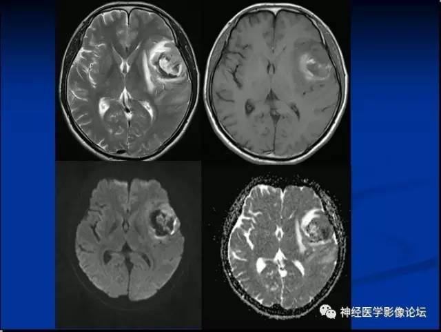 【病例】左颞叶胶质肉瘤1例CT及MR影像表现 【病例】左颞叶胶质肉瘤1例CT及MR影像表现