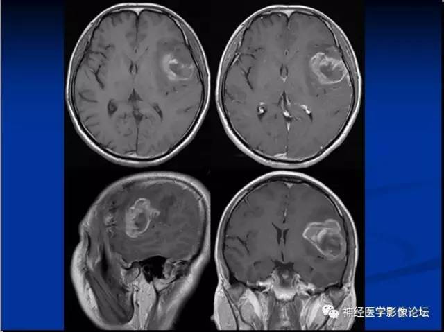 【病例】左颞叶胶质肉瘤1例CT及MR影像表现 【病例】左颞叶胶质肉瘤1例CT及MR影像表现