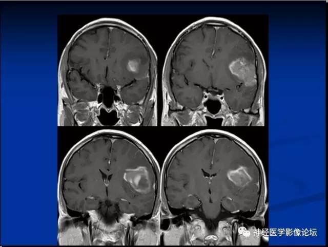 【病例】左颞叶胶质肉瘤1例CT及MR影像表现 【病例】左颞叶胶质肉瘤1例CT及MR影像表现