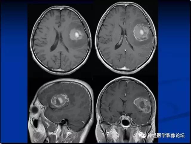 【病例】左颞叶胶质肉瘤1例CT及MR影像表现 【病例】左颞叶胶质肉瘤1例CT及MR影像表现