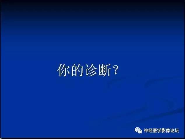 【病例】左颞叶胶质肉瘤1例CT及MR影像表现 【病例】左颞叶胶质肉瘤1例CT及MR影像表现
