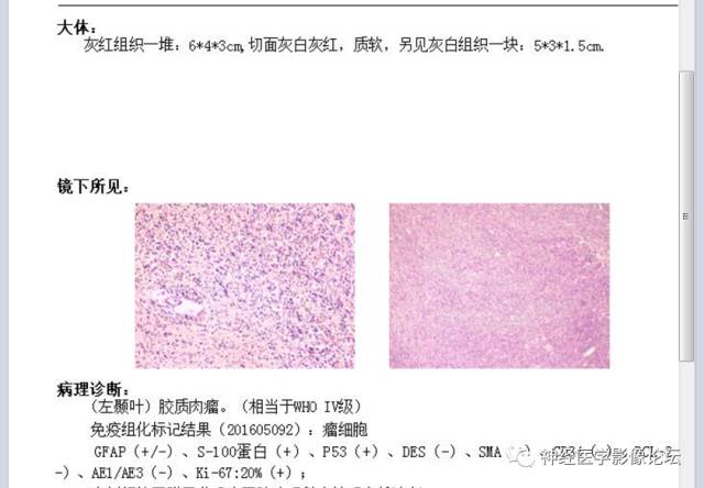 【病例】左颞叶胶质肉瘤1例CT及MR影像表现 【病例】左颞叶胶质肉瘤1例CT及MR影像表现