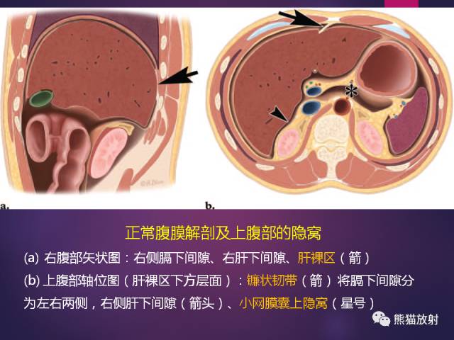 【PPT】原发性腹膜肿瘤的影像表现 【PPT】原发性腹膜肿瘤的影像表现