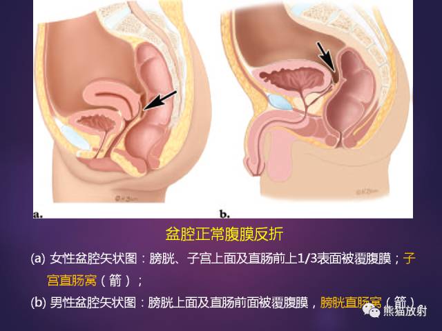 【PPT】原发性腹膜肿瘤的影像表现 【PPT】原发性腹膜肿瘤的影像表现