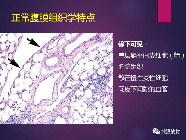 【PPT】原发性腹膜肿瘤的影像表现 【PPT】原发性腹膜肿瘤的影像表现