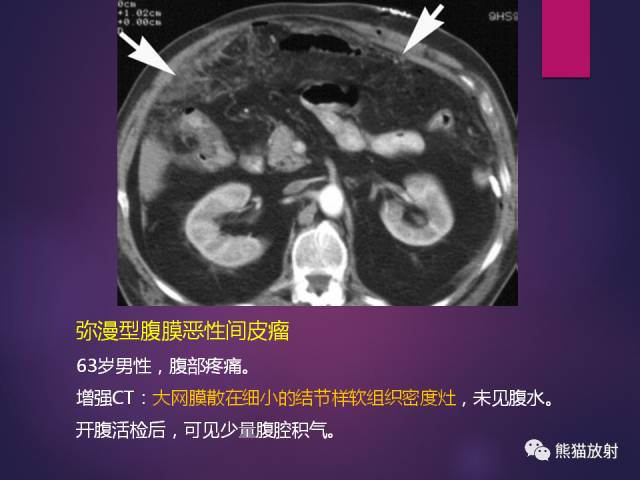 【PPT】原发性腹膜肿瘤的影像表现 【PPT】原发性腹膜肿瘤的影像表现