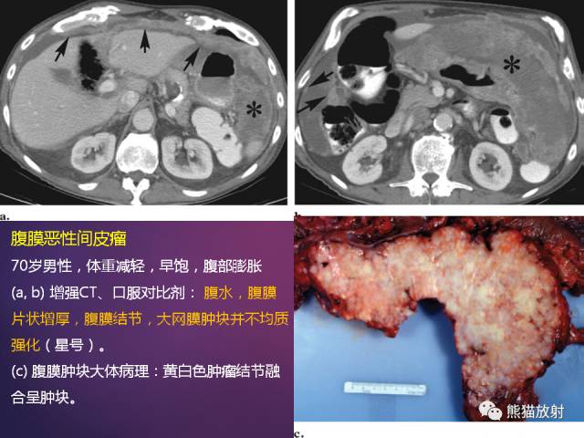 【PPT】原发性腹膜肿瘤的影像表现 【PPT】原发性腹膜肿瘤的影像表现