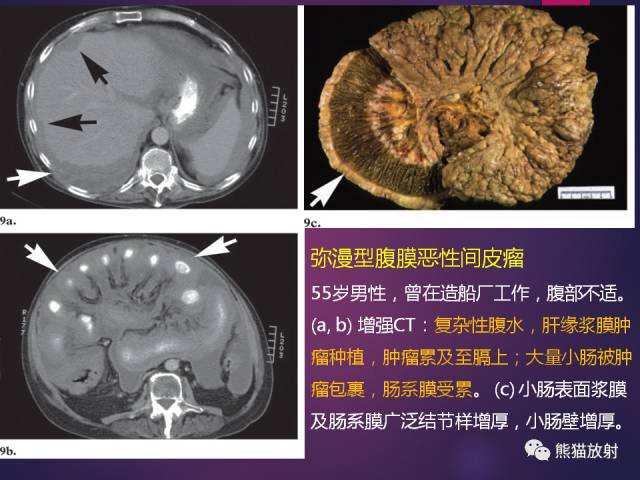 【PPT】原发性腹膜肿瘤的影像表现 【PPT】原发性腹膜肿瘤的影像表现
