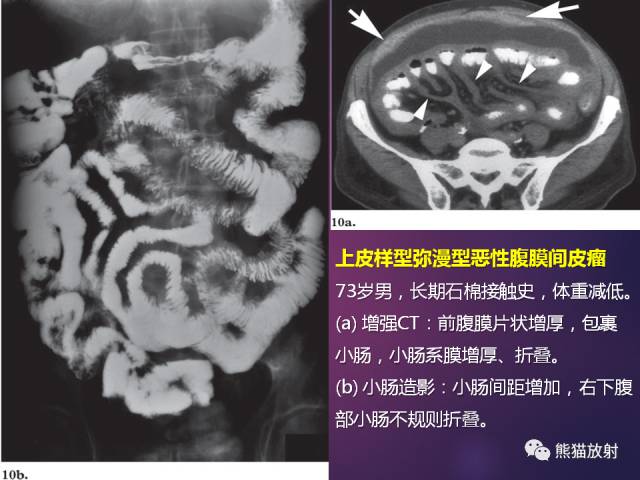 【PPT】原发性腹膜肿瘤的影像表现 【PPT】原发性腹膜肿瘤的影像表现