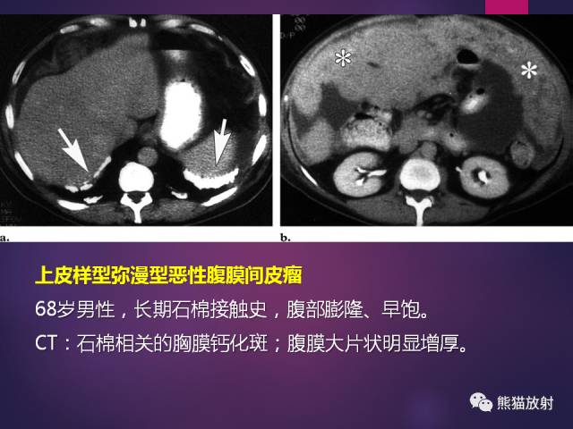 【PPT】原发性腹膜肿瘤的影像表现 【PPT】原发性腹膜肿瘤的影像表现