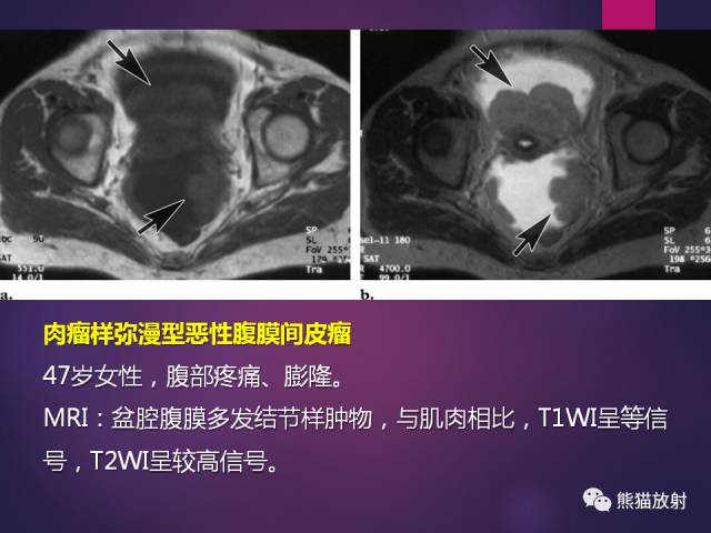 【PPT】原发性腹膜肿瘤的影像表现 【PPT】原发性腹膜肿瘤的影像表现