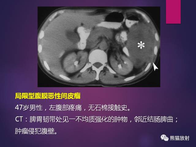 【PPT】原发性腹膜肿瘤的影像表现 【PPT】原发性腹膜肿瘤的影像表现