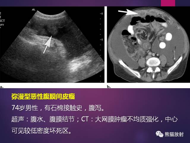【PPT】原发性腹膜肿瘤的影像表现 【PPT】原发性腹膜肿瘤的影像表现