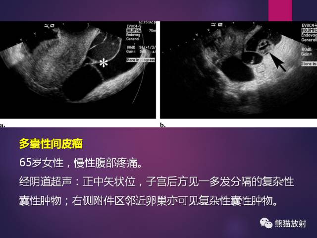 【PPT】原发性腹膜肿瘤的影像表现 【PPT】原发性腹膜肿瘤的影像表现