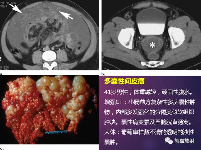 【PPT】原发性腹膜肿瘤的影像表现 【PPT】原发性腹膜肿瘤的影像表现