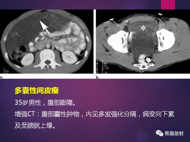 【PPT】原发性腹膜肿瘤的影像表现 【PPT】原发性腹膜肿瘤的影像表现