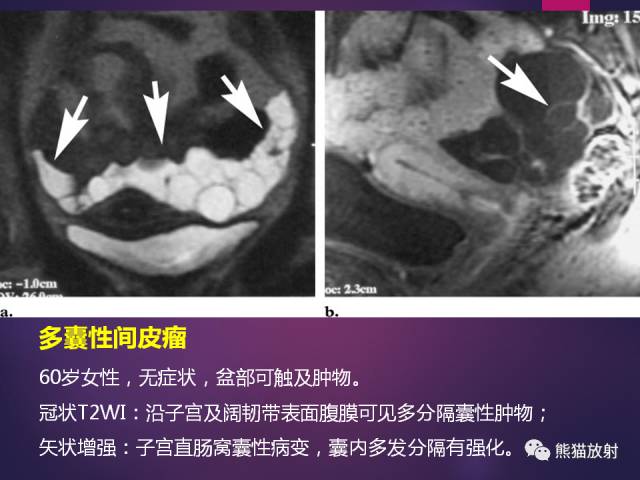 【PPT】原发性腹膜肿瘤的影像表现 【PPT】原发性腹膜肿瘤的影像表现