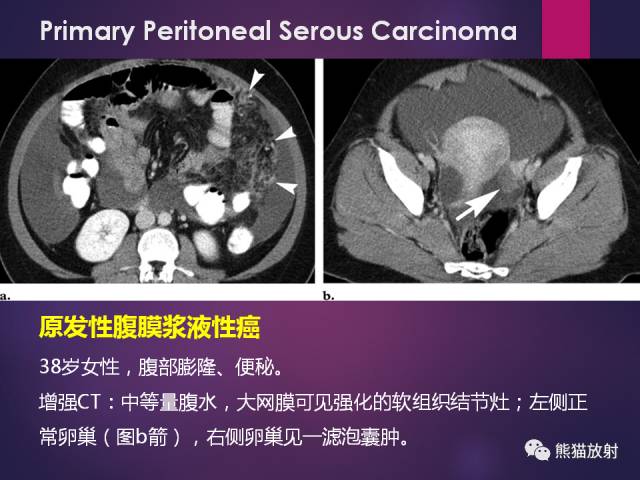 【PPT】原发性腹膜肿瘤的影像表现 【PPT】原发性腹膜肿瘤的影像表现