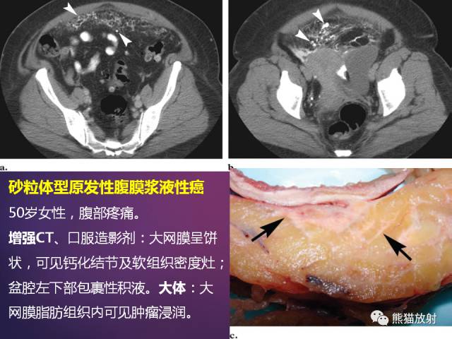 【PPT】原发性腹膜肿瘤的影像表现 【PPT】原发性腹膜肿瘤的影像表现