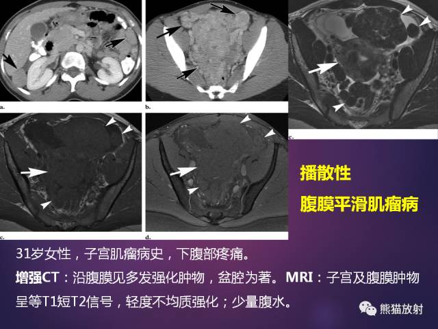 【PPT】原发性腹膜肿瘤的影像表现 【PPT】原发性腹膜肿瘤的影像表现