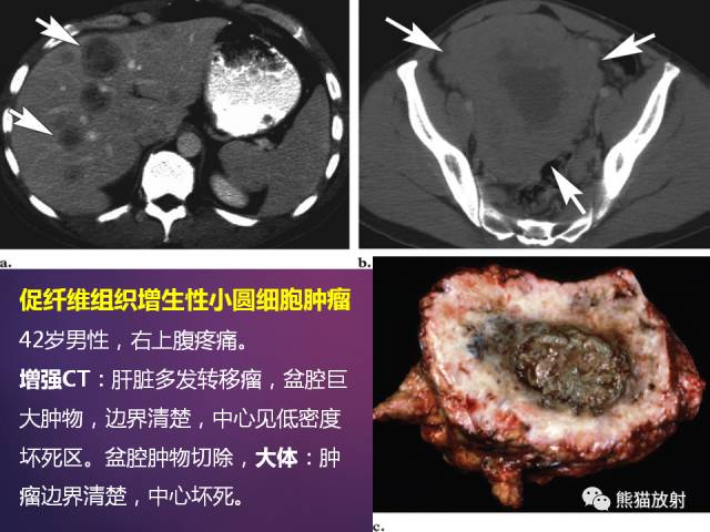 【PPT】原发性腹膜肿瘤的影像表现 【PPT】原发性腹膜肿瘤的影像表现