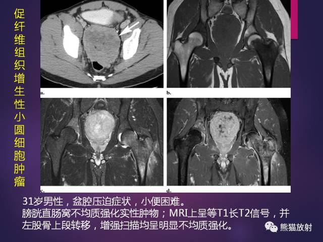 【PPT】原发性腹膜肿瘤的影像表现 【PPT】原发性腹膜肿瘤的影像表现