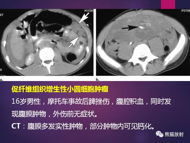 【PPT】原发性腹膜肿瘤的影像表现 【PPT】原发性腹膜肿瘤的影像表现