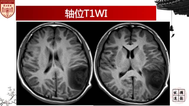 【病例】脑血吸虫性肉芽肿1例MR