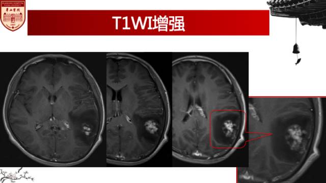 【病例】脑血吸虫性肉芽肿1例MR