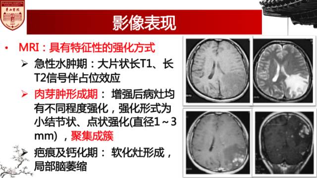 【病例】脑血吸虫性肉芽肿1例MR