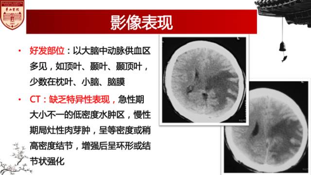 【病例】脑血吸虫性肉芽肿1例MR
