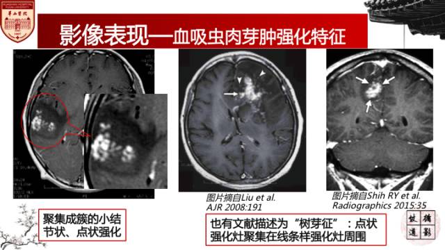 【病例】脑血吸虫性肉芽肿1例MR