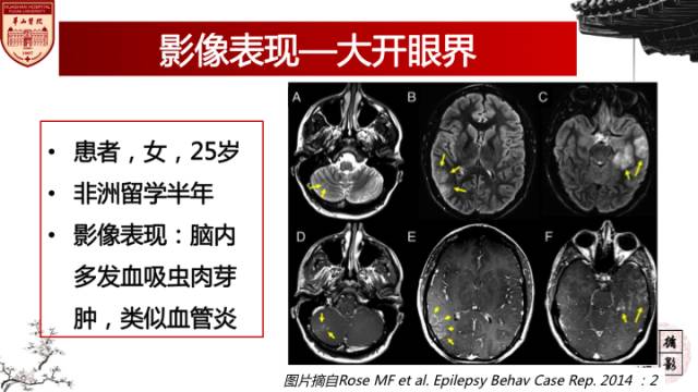 【病例】脑血吸虫性肉芽肿1例MR