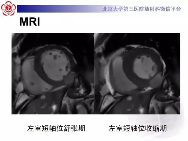 【病例】假性室壁瘤1例MR影像表现