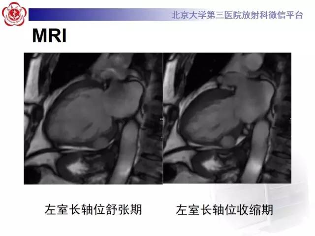 【病例】假性室壁瘤1例MR影像表现