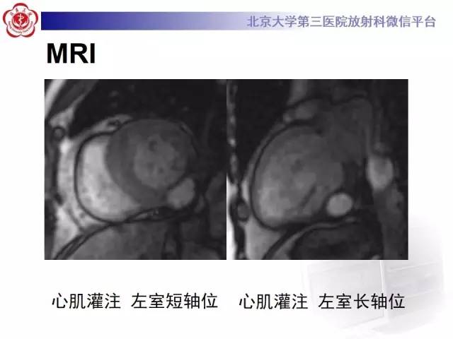 【病例】假性室壁瘤1例MR影像表现