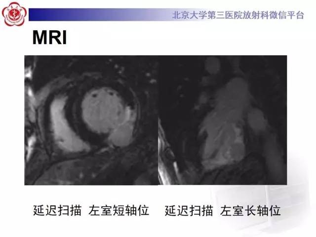 【病例】假性室壁瘤1例MR影像表现
