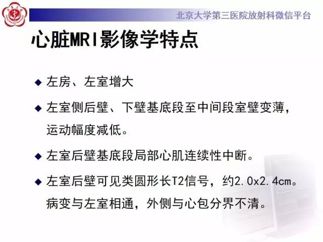 【病例】假性室壁瘤1例MR影像表现
