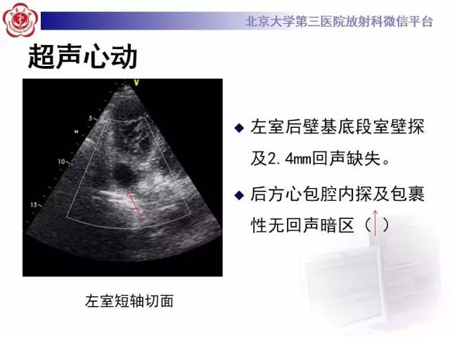 【病例】假性室壁瘤1例MR影像表现